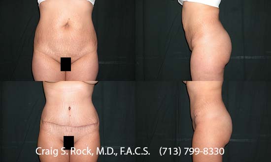 Breast Augmentation Using Silicone Implants - Patient 1