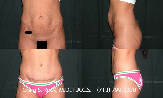 Breast Augmentation Using Silicone Implants - Patient 1