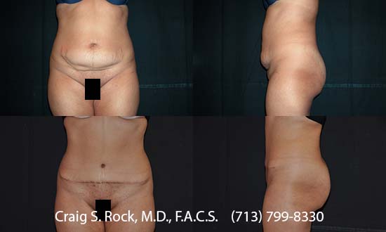 Breast Augmentation Using Silicone Implants - Patient 1