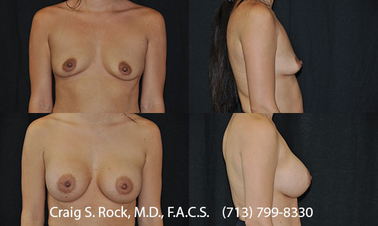 Breast Augmentation Using Cohesive Silicone Implants - Patient 2