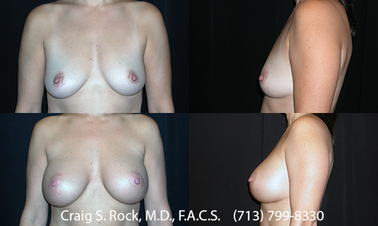 Breast Augmentation Using Silicone Implants - Patient 1