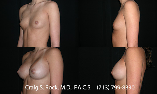Breast Augmentation Using Silicone Implants - Patient 1