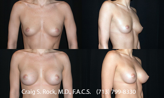 Breast Augmentation Using Silicone Implants - Patient 1
