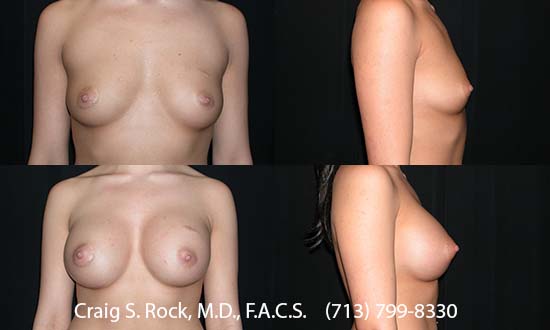 Breast Augmentation Using Silicone Implants - Patient 1