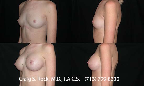 Breast Augmentation Using Silicone Implants - Patient 1