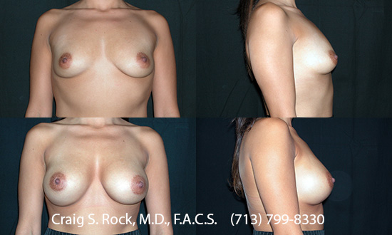 Breast Augmentation Using Silicone Implants - Patient 1