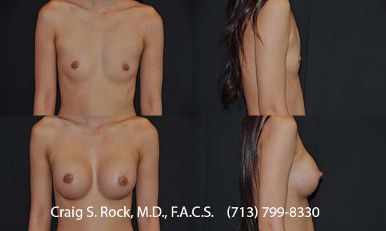 Breast Augmentation Using Silicone Implants - Patient 1