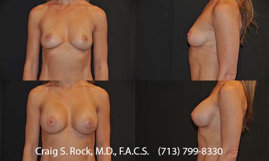 Breast Augmentation Using Silicone Implants - Patient 12
