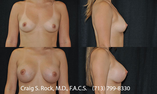 Breast Augmentation Using Silicone Implants - Patient 13