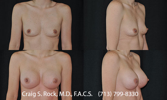 Breast Augmentation Using Silicone Implants - Patient 15