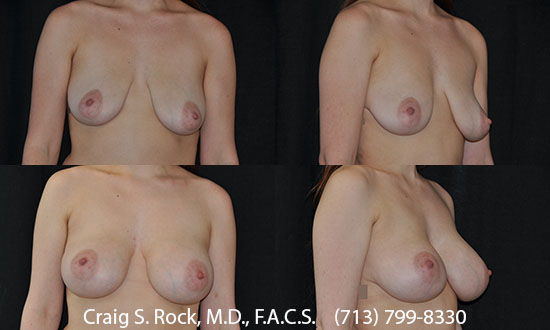 Breast Augmentation Using Silicone Implants - Patient 16