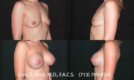 Breast Augmentation Using Silicone Implants - Patient 1