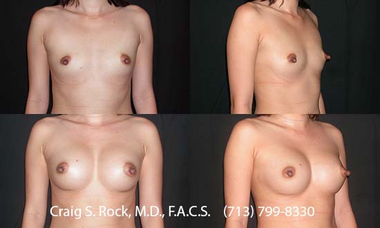 Breast Augmentation Using Silicone Implants - Patient 3