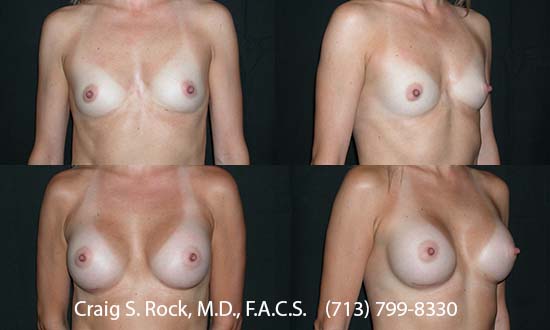 Breast Augmentation Using Silicone Implants - Patient 4