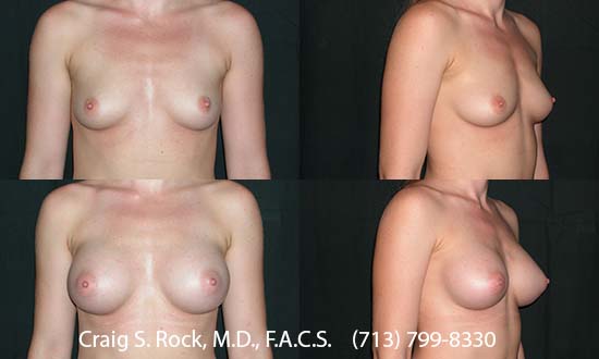 Breast Augmentation Using Silicone Implants - Patient 1