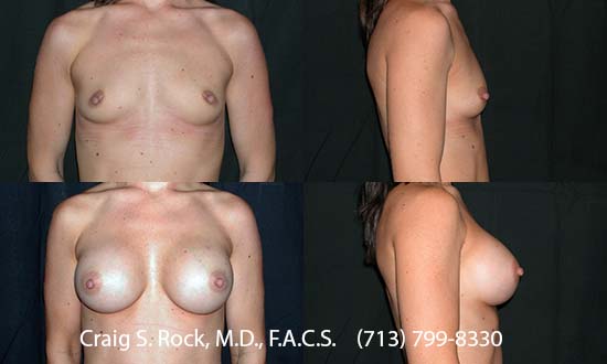 Breast Augmentation Using Silicone Implants - Patient 1