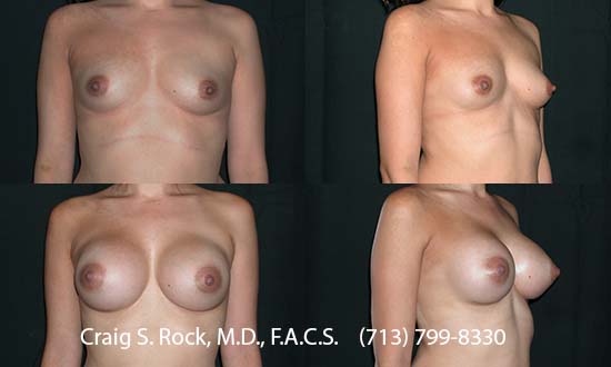 Breast Augmentation Using Silicone Implants - Patient 1