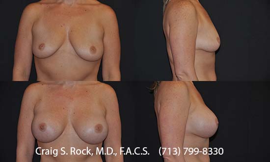 Breast Augmentation Using Silicone Implants - Patient 1