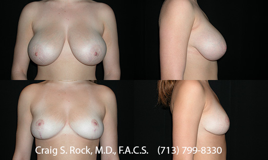 Breast Augmentation Using Silicone Implants - Patient 1