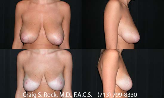 Breast Augmentation Using Silicone Implants - Patient 1