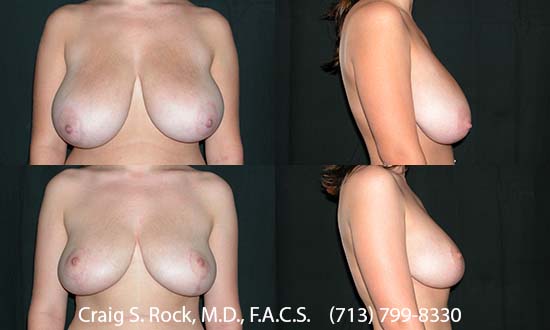 Breast Augmentation Using Silicone Implants - Patient 1
