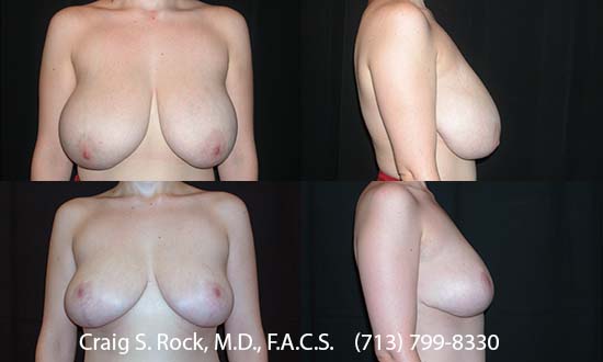 Breast Augmentation Using Silicone Implants - Patient 1