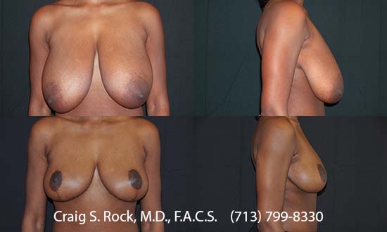 Breast Augmentation Using Silicone Implants - Patient 1